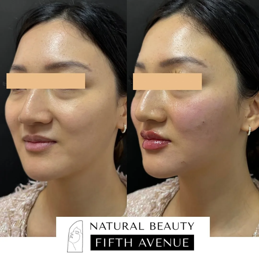Before and after dermal fillers treatment showing patient profile with enhanced cheek and lip fullness